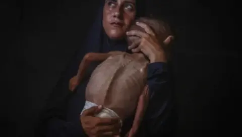 One-and-a-half-year-old Muhammed Zakariya Ayyub al-Matouk, one of thousands of children suffering from hunger and malnutrition in Gaza, faces life-threatening conditions due to Israel's ongoing attacks and blockade in Gaza City, Gaza on July 24, 2025. Photo by Anadolu Images.